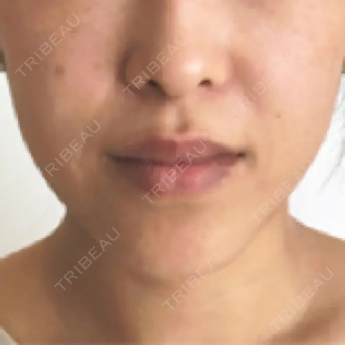 その他（目元） / その他（口元） 衣理クリニック表参道 AFTER メイン用