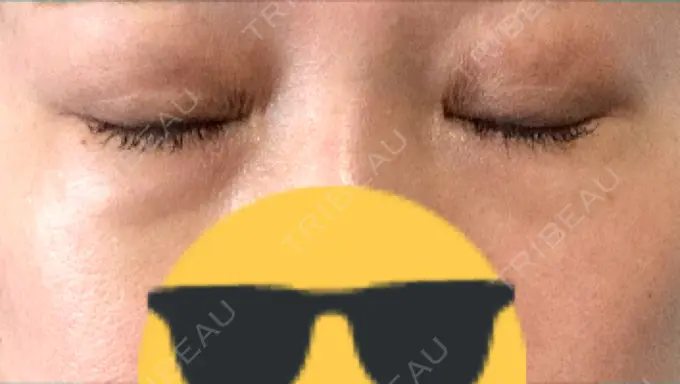 ヒアルロン酸注入（目の下） 渋谷美容外科クリニック 渋谷院 DAY 9 メイン用