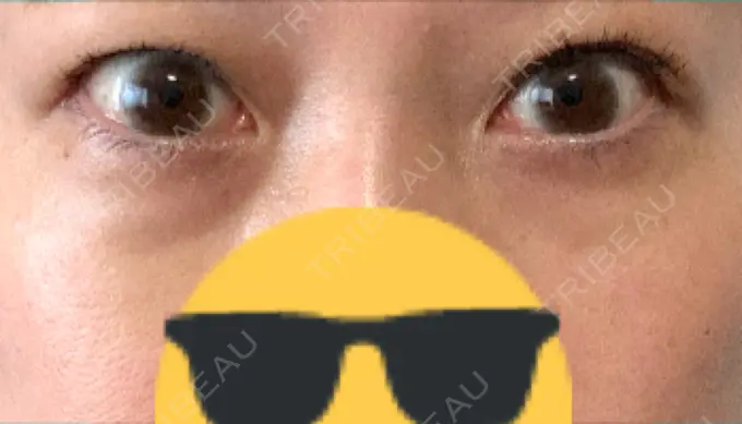 ヒアルロン酸注入（目の下） 渋谷美容外科クリニック 渋谷院 DAY 9 メイン用