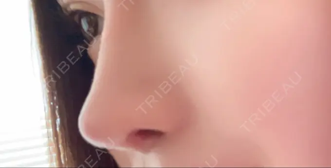 隆鼻術 / 鼻中隔延長（切開） / 鼻修正 / 鼻孔縁下降 / その他（鼻） みずほクリニック DAY 86 メイン用