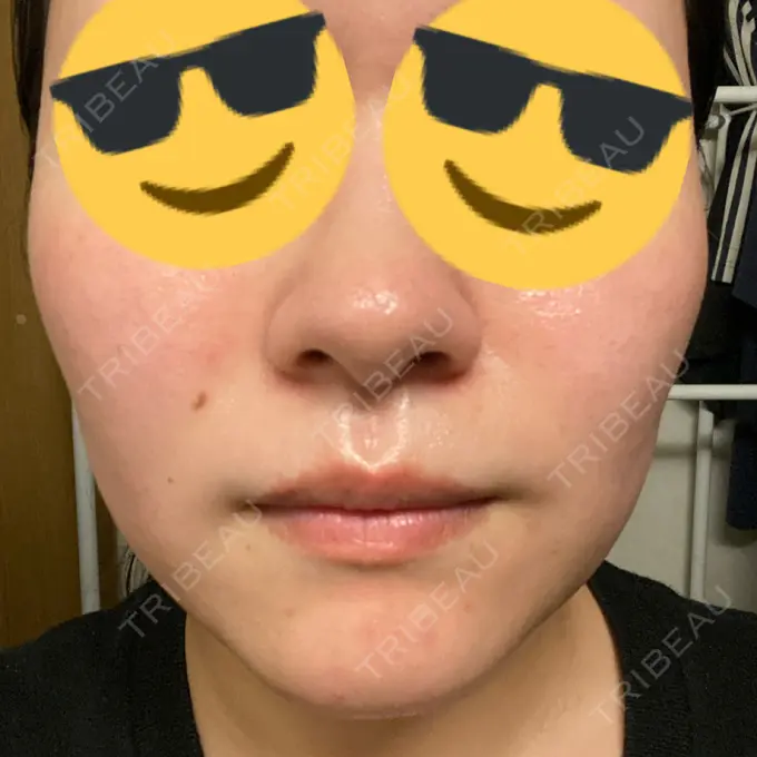 ダーマペン / 毛穴洗浄（ハイドラフェイシャルなど） まゆりなclinic 名古屋栄 DAY 3 メイン用