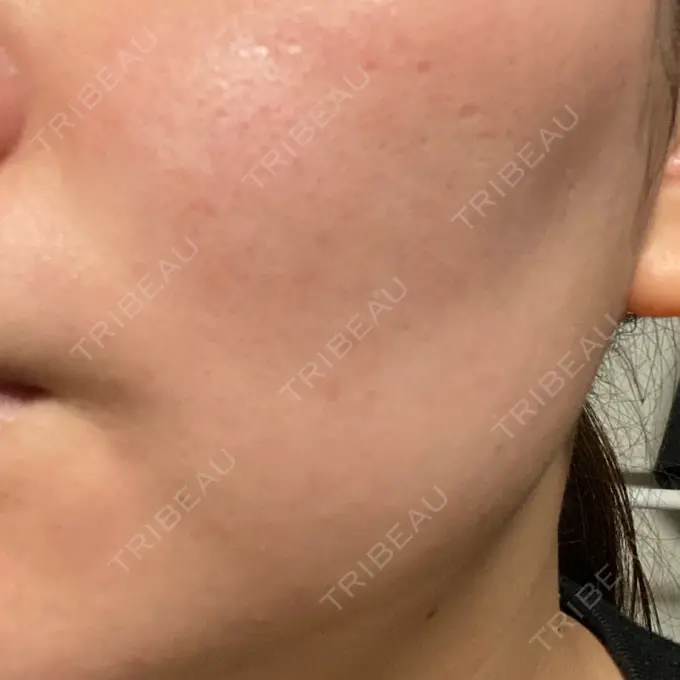 ダーマペン / 毛穴洗浄（ハイドラフェイシャルなど） まゆりなclinic 名古屋栄 DAY 3 メイン用