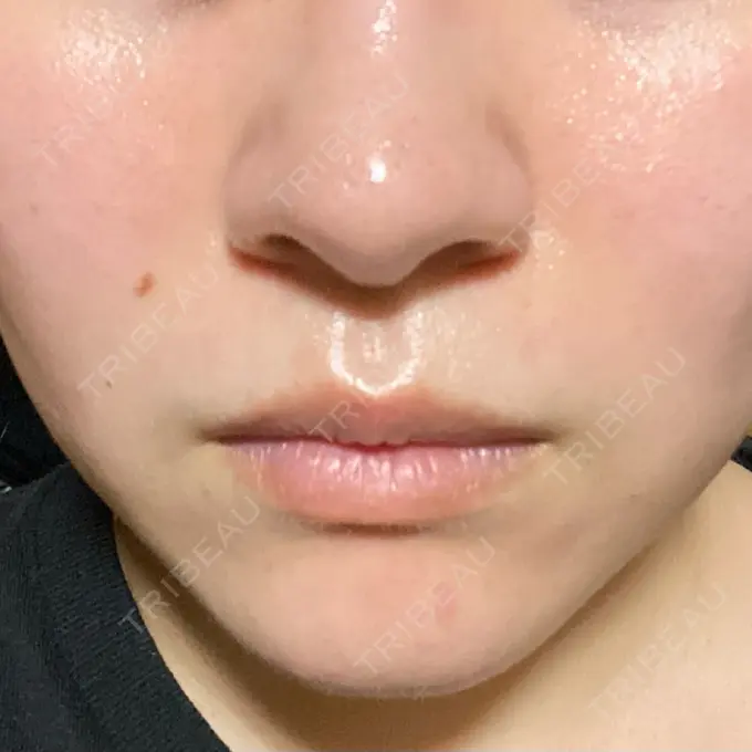 ダーマペン / 毛穴洗浄（ハイドラフェイシャルなど） まゆりなclinic 名古屋栄 DAY 4 メイン用