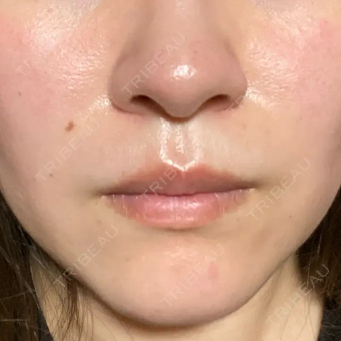 ダーマペン / 毛穴洗浄（ハイドラフェイシャルなど） まゆりなclinic 名古屋栄 DAY 5 メイン用