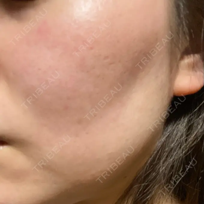 ダーマペン / 毛穴洗浄（ハイドラフェイシャルなど） まゆりなclinic 名古屋栄 DAY 5 メイン用