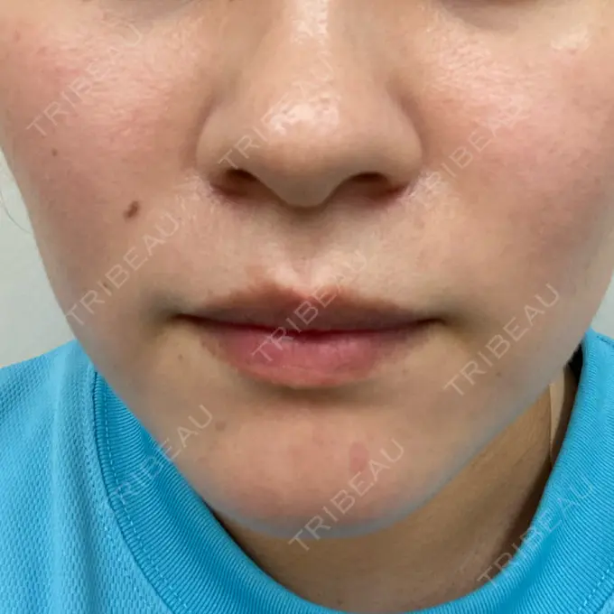 ダーマペン / 毛穴洗浄（ハイドラフェイシャルなど） まゆりなclinic 名古屋栄 DAY 6 メイン用