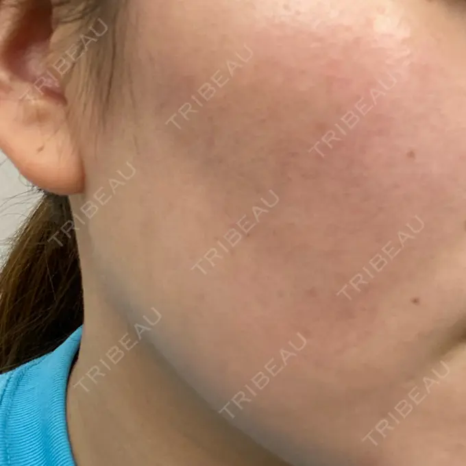 ダーマペン / 毛穴洗浄（ハイドラフェイシャルなど） まゆりなclinic 名古屋栄 DAY 6 メイン用