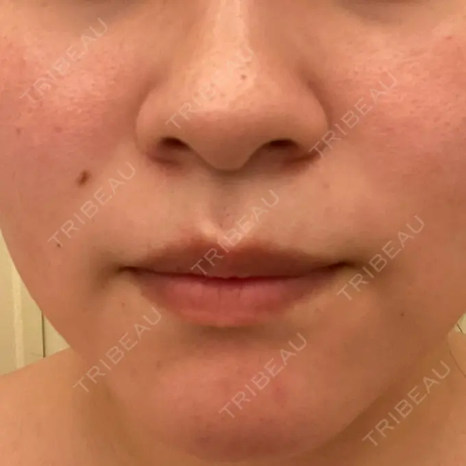 ダーマペン / 毛穴洗浄（ハイドラフェイシャルなど） まゆりなclinic 名古屋栄 DAY 11 メイン用