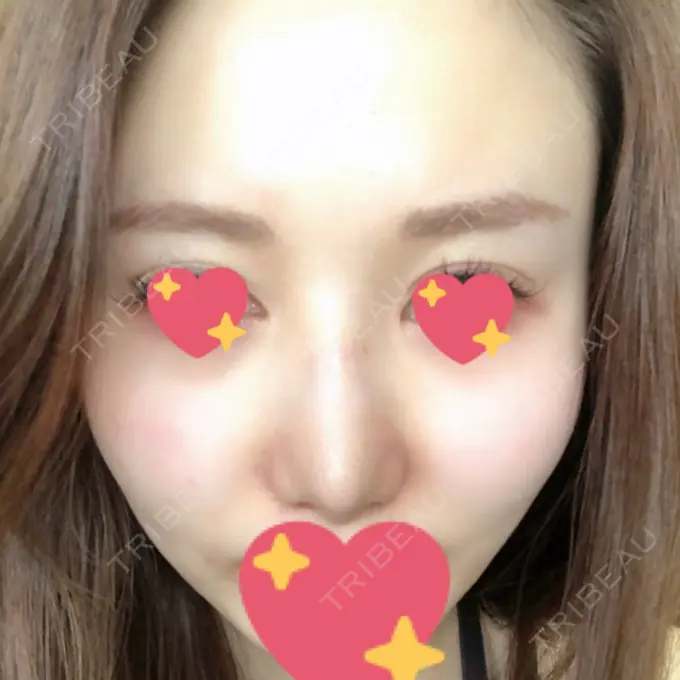 軟骨移植 / ワシ鼻修正・ハンプ切除 / 鼻尖縮小 聖心美容クリニック 名古屋院 AFTER メイン用