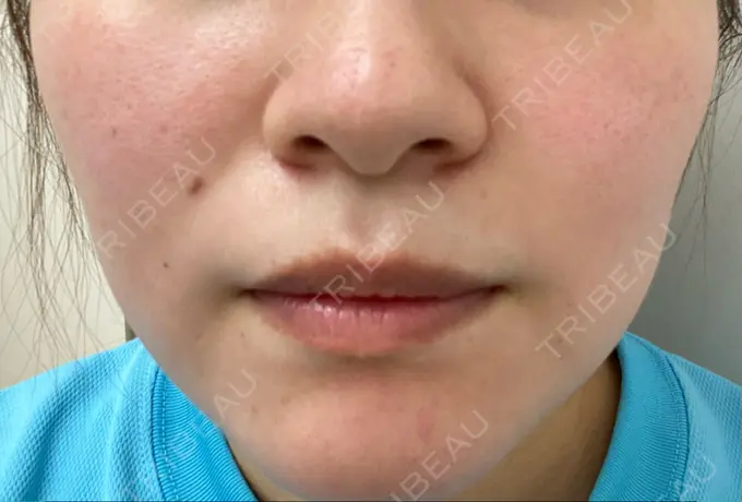 ダーマペン / 毛穴洗浄（ハイドラフェイシャルなど） まゆりなclinic 名古屋栄 AFTER メイン用