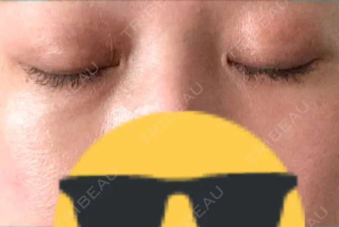 ヒアルロン酸注入（目の下） 渋谷美容外科クリニック 渋谷院 AFTER メイン用