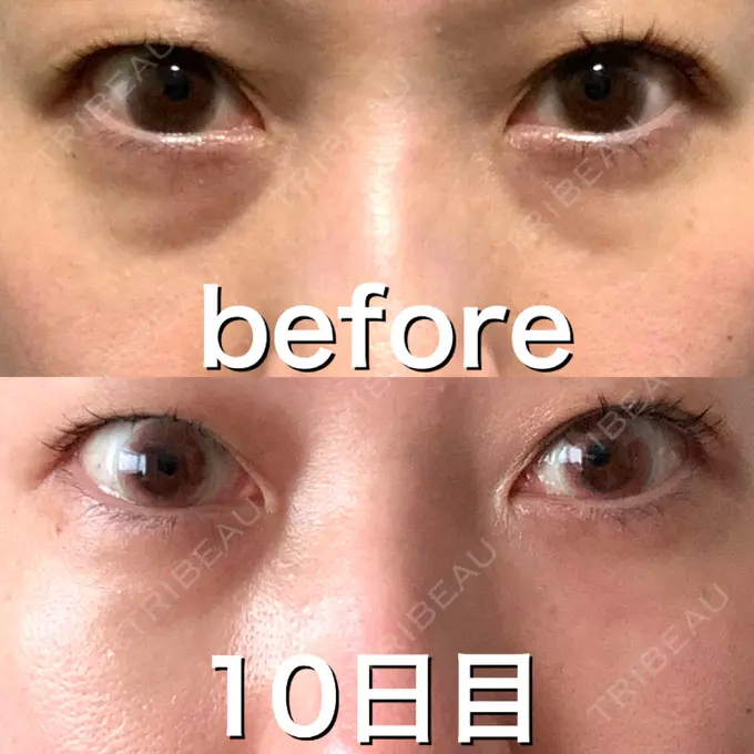 ヒアルロン酸注入（目の下） 渋谷美容外科クリニック 渋谷院 DAY 10 メイン用
