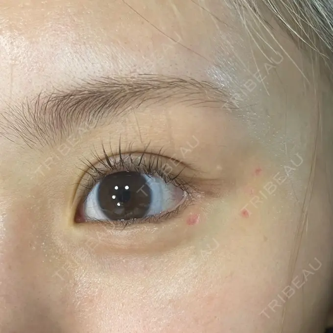 ほくろ・いぼ除去レーザー（肌） Fellez Clinic【フェルズクリニック】 DAY 7 メイン用