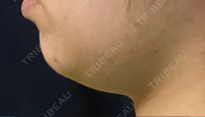 脂肪溶解注射（顔） 東京ロイヤルクリニック DAY 17 メイン用