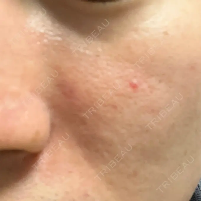 ピーリング（ニキビ・毛穴） / ダーマペン オーマイクリニック【Oh My Clinic】 AFTER メイン用