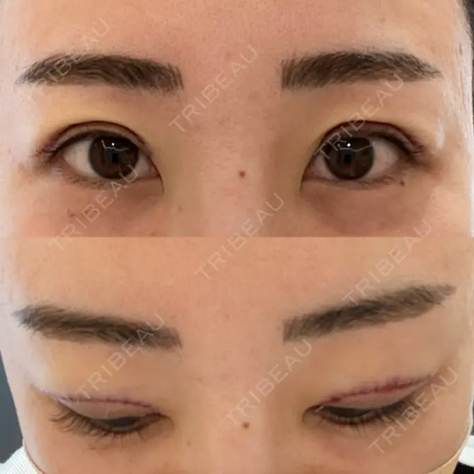 上まぶたたるみ取り e:Top clinic（イートップクリニック） DAY 0 メイン用