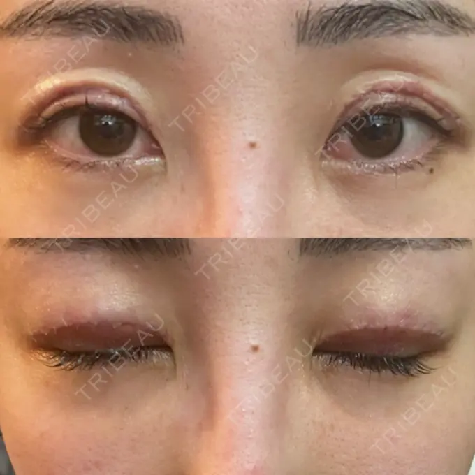 上まぶたたるみ取り e:Top clinic（イートップクリニック） DAY 1 メイン用