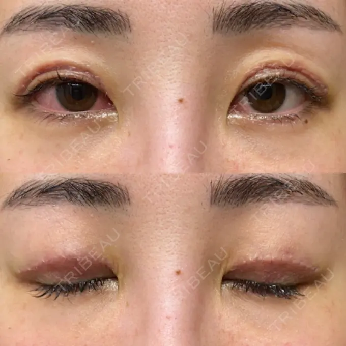 上まぶたたるみ取り e:Top clinic（イートップクリニック） DAY 2 メイン用