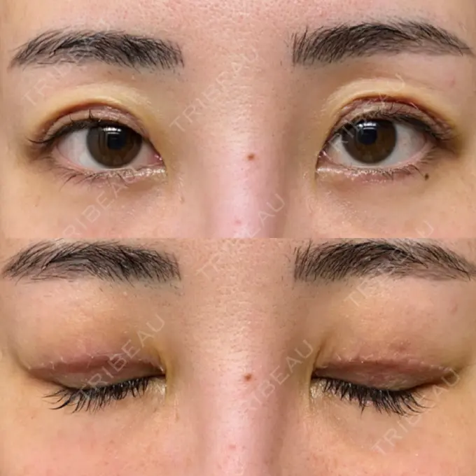 上まぶたたるみ取り e:Top clinic（イートップクリニック） DAY 3 メイン用