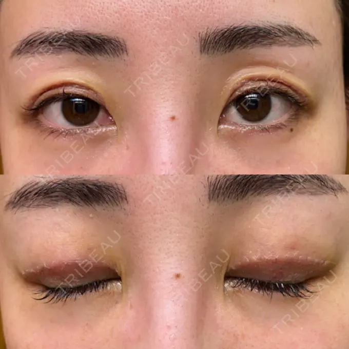 上まぶたたるみ取り e:Top clinic（イートップクリニック） DAY 4 メイン用