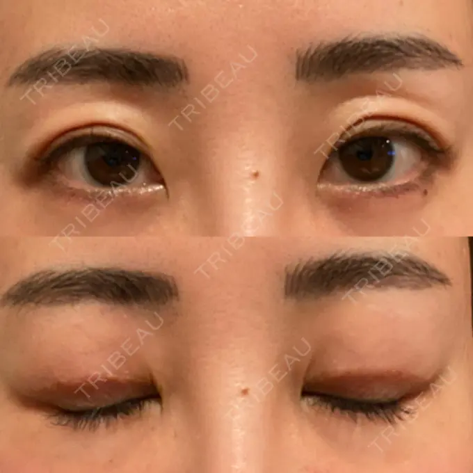 上まぶたたるみ取り e:Top clinic（イートップクリニック） DAY 7 メイン用