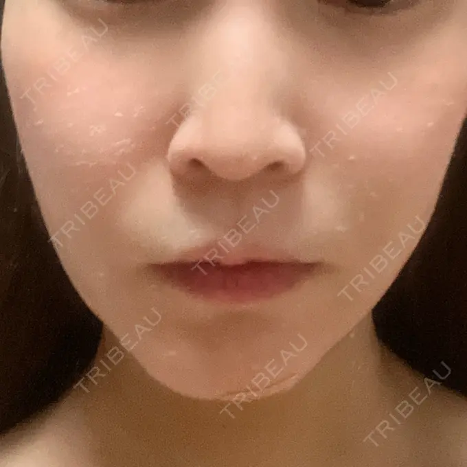 糸リフト / 脂肪吸引（顔） / ヒアルロン酸注入（額） 東京ミッドクリニック DAY 5 メイン用