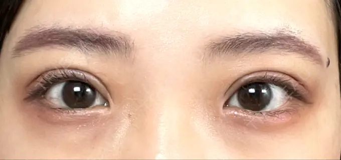 二重切開 / その他（目元） LIKI CLINIC KOBE DAY 13 メイン用