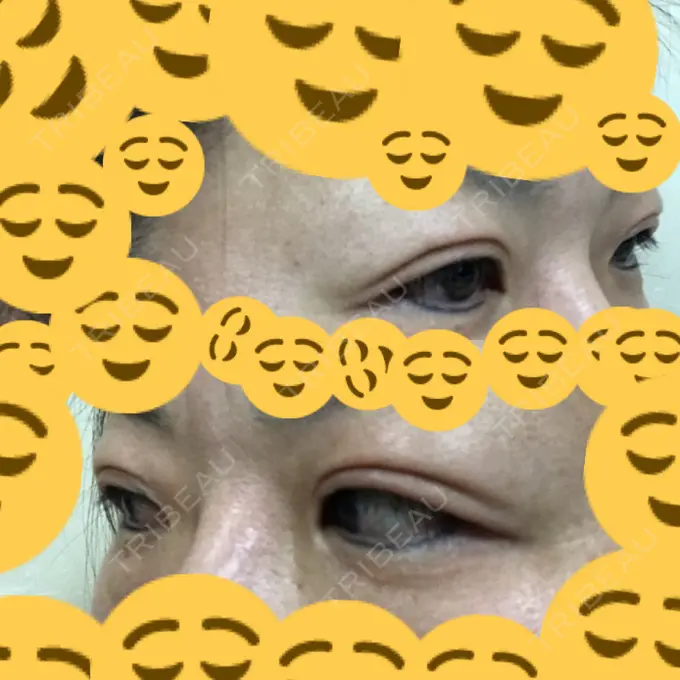 二重埋没 神戸元町ビューティークリニック DAY 372 メイン用