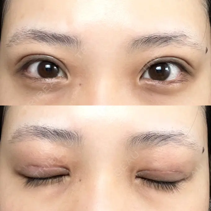 二重切開 / その他（目元） LIKI CLINIC KOBE DAY 16 メイン用