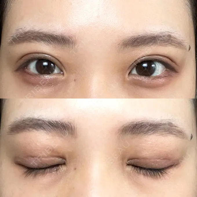 二重切開 / その他（目元） LIKI CLINIC KOBE DAY 16 メイン用