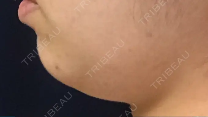 脂肪溶解注射（顔） 東京ロイヤルクリニック DAY 20 メイン用