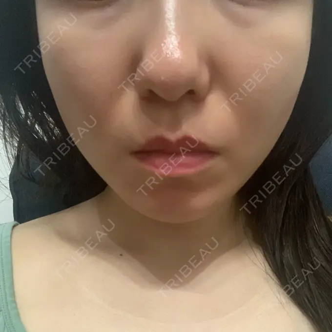 糸リフト / 脂肪吸引（顔） / メーラーファット除去 / ボトックス（エラ・小顔） 湘南美容クリニック 秋葉原院 AFTER メイン用