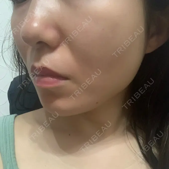 糸リフト / 脂肪吸引（顔） / メーラーファット除去 / ボトックス（エラ・小顔） 湘南美容クリニック 秋葉原院 DAY 377 メイン用