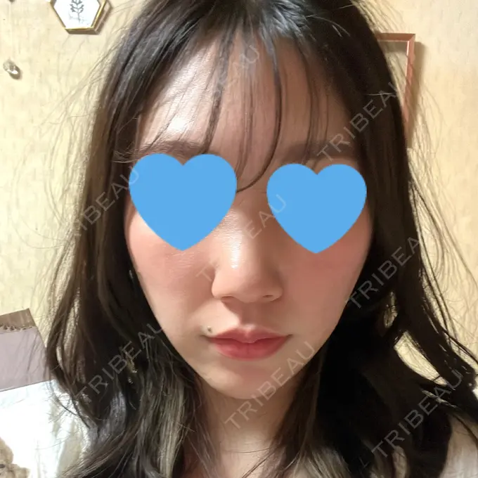 糸リフト / 脂肪吸引（顔） 湘南美容クリニック 長野院 DAY 170 メイン用