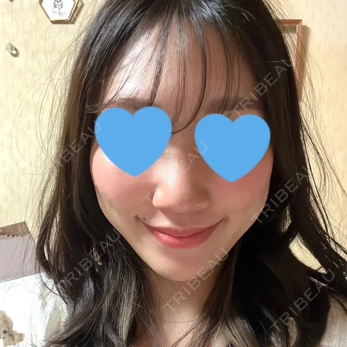 糸リフト / 脂肪吸引（顔） 湘南美容クリニック 長野院 DAY 170 メイン用