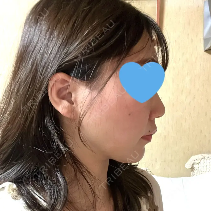 糸リフト / 脂肪吸引（顔） 湘南美容クリニック 長野院 DAY 170 メイン用