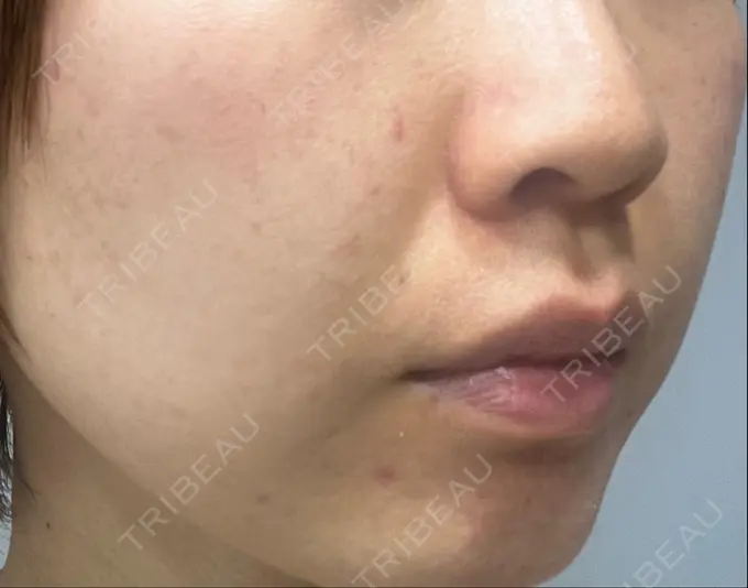 ハイフ（顔） STARS CLINIC DAY 88 メイン用