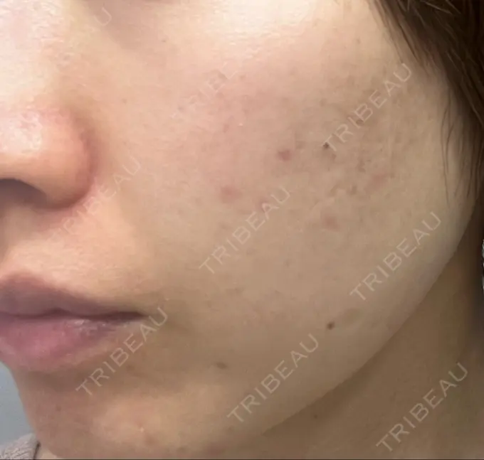 ハイフ（顔） STARS CLINIC DAY 88 メイン用