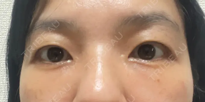 クマ治療 / 下まぶたたるみ取り セオリークリニック DAY 22 メイン用