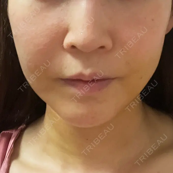 糸リフト / 脂肪吸引（顔） / ヒアルロン酸注入（額） 東京ミッドクリニック DAY 8 メイン用