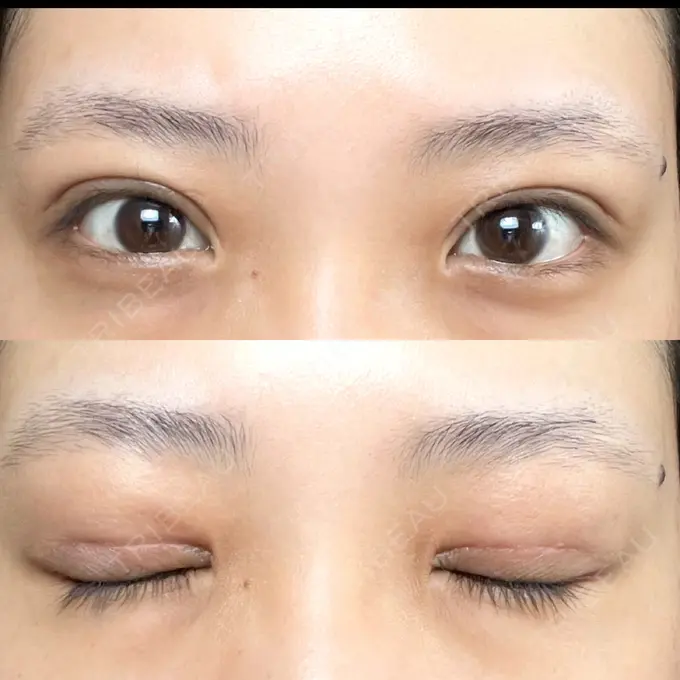 二重切開 / その他（目元） LIKI CLINIC KOBE DAY 20 メイン用