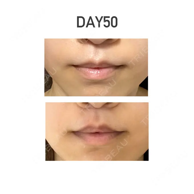 人中短縮 新宿ラクル美容外科クリニック 新宿院 DAY 50 メイン用