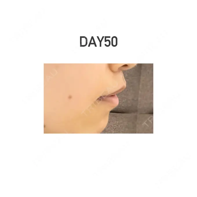 人中短縮 新宿ラクル美容外科クリニック 新宿院 DAY 50 メイン用