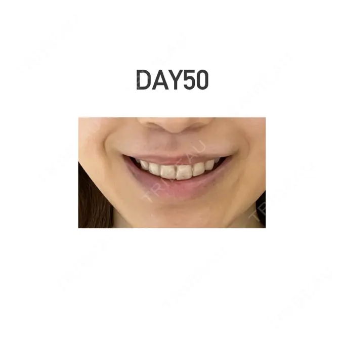 人中短縮 新宿ラクル美容外科クリニック 新宿院 DAY 50 メイン用