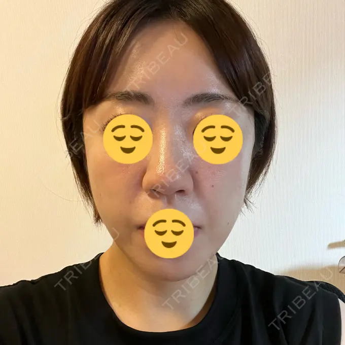 糸リフト / ボトックス（エラ・小顔） / 脂肪溶解注射（顔） X CLINIC 福岡天神院 DAY 1 メイン用