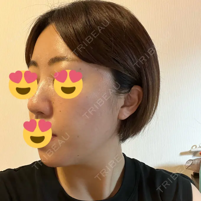 糸リフト / ボトックス（エラ・小顔） / 脂肪溶解注射（顔） X CLINIC 福岡天神院 DAY 1 メイン用