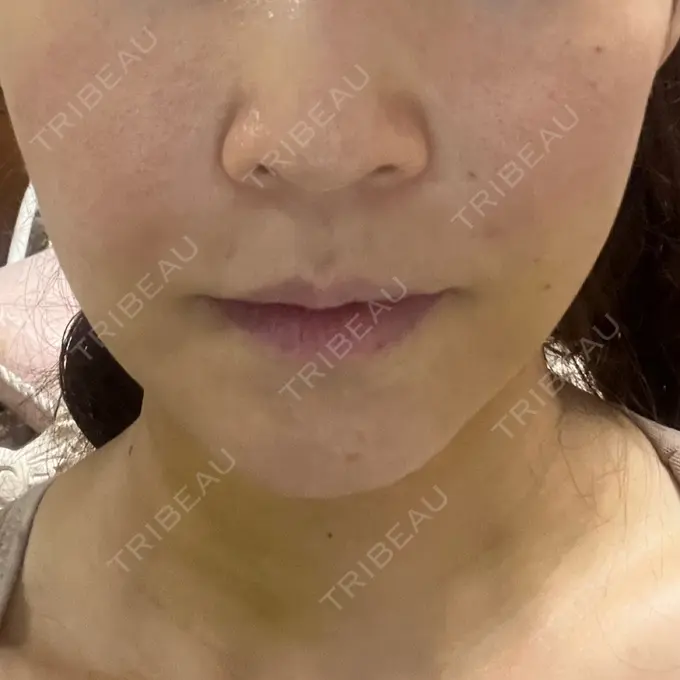 糸リフト / 脂肪吸引（顔） / ヒアルロン酸注入（額） 東京ミッドクリニック DAY 10 メイン用