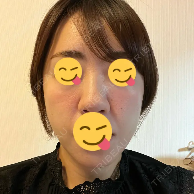 糸リフト / ボトックス（エラ・小顔） / 脂肪溶解注射（顔） X CLINIC 福岡天神院 DAY 2 メイン用