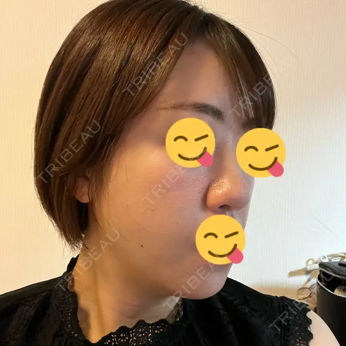 糸リフト / ボトックス（エラ・小顔） / 脂肪溶解注射（顔） X CLINIC 福岡天神院 DAY 2 メイン用