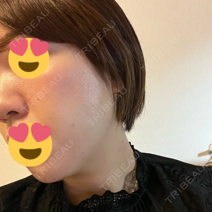 糸リフト / ボトックス（エラ・小顔） / 脂肪溶解注射（顔） X CLINIC 福岡天神院 DAY 2 メイン用